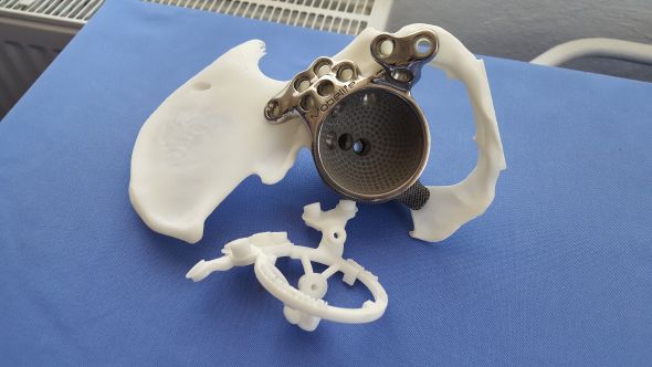 3D tisk kovů má široké uplatnění i v medicíně. Vytištěný titanový kyčelní kloub